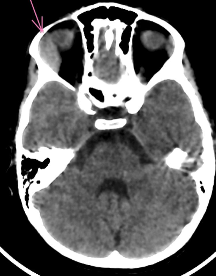 https://cdn.ncbi.nlm.nih.gov/pmc/blobs/4fd8/12264361/01092e2c3fac/cureus-0017-00000085975-i02.jpg
