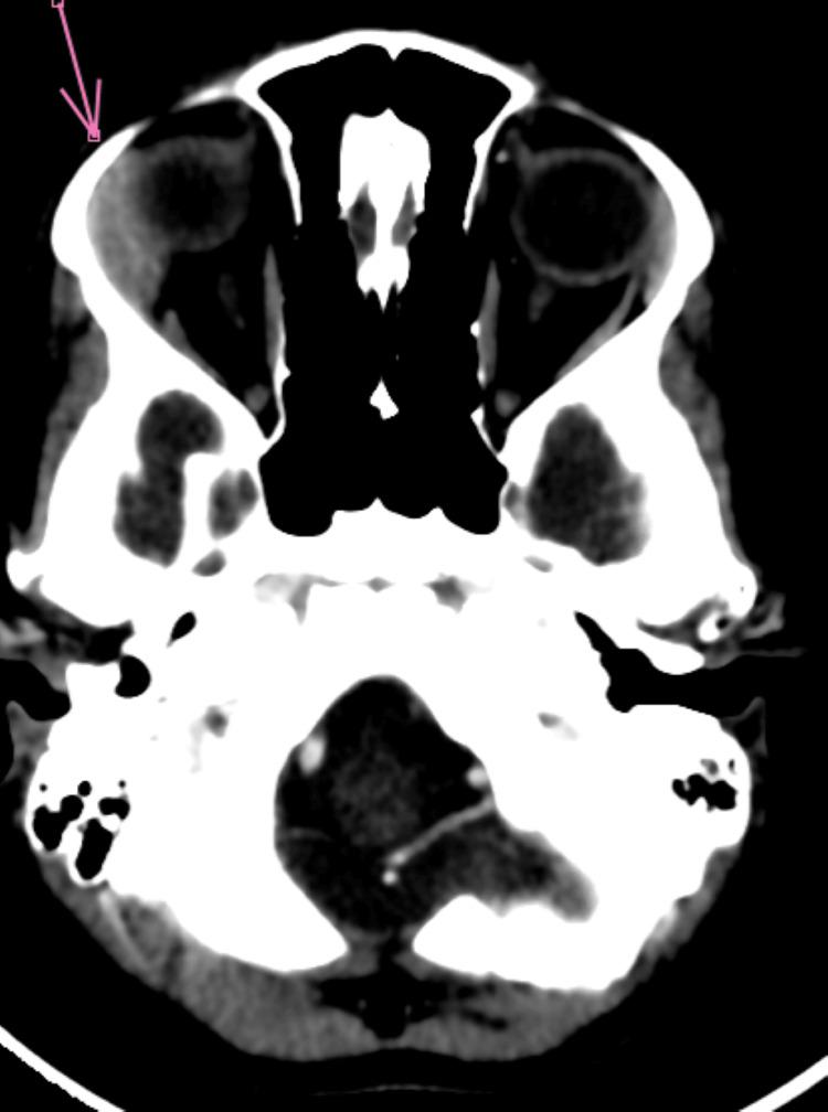 https://cdn.ncbi.nlm.nih.gov/pmc/blobs/4fd8/12264361/232607a8d351/cureus-0017-00000085975-i03.jpg