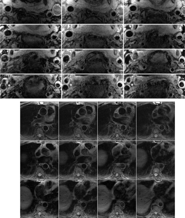 https://cdn.ncbi.nlm.nih.gov/pmc/blobs/4feb/2848016/4d733fd3147b/1532-429X-12-10-1.jpg