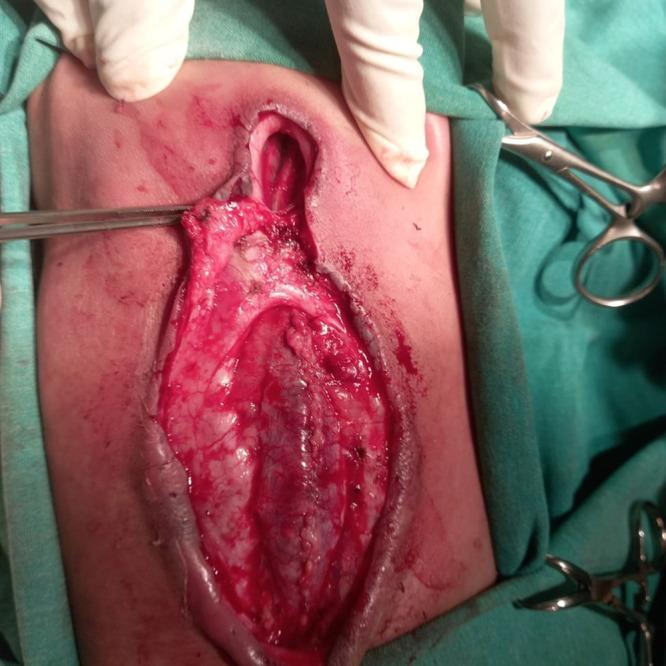 https://cdn.ncbi.nlm.nih.gov/pmc/blobs/4ff1/9514283/e7bf11d0760d/CASE22220f3.jpg