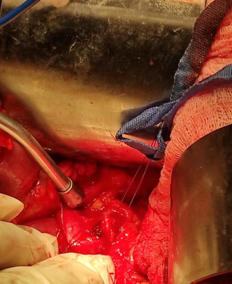 https://cdn.ncbi.nlm.nih.gov/pmc/blobs/4ffe/8297111/0336811e972b/cureus-0013-00000015827-i05.jpg