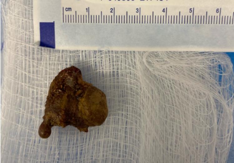https://cdn.ncbi.nlm.nih.gov/pmc/blobs/4ffe/8297111/3f25849108b0/cureus-0013-00000015827-i08.jpg