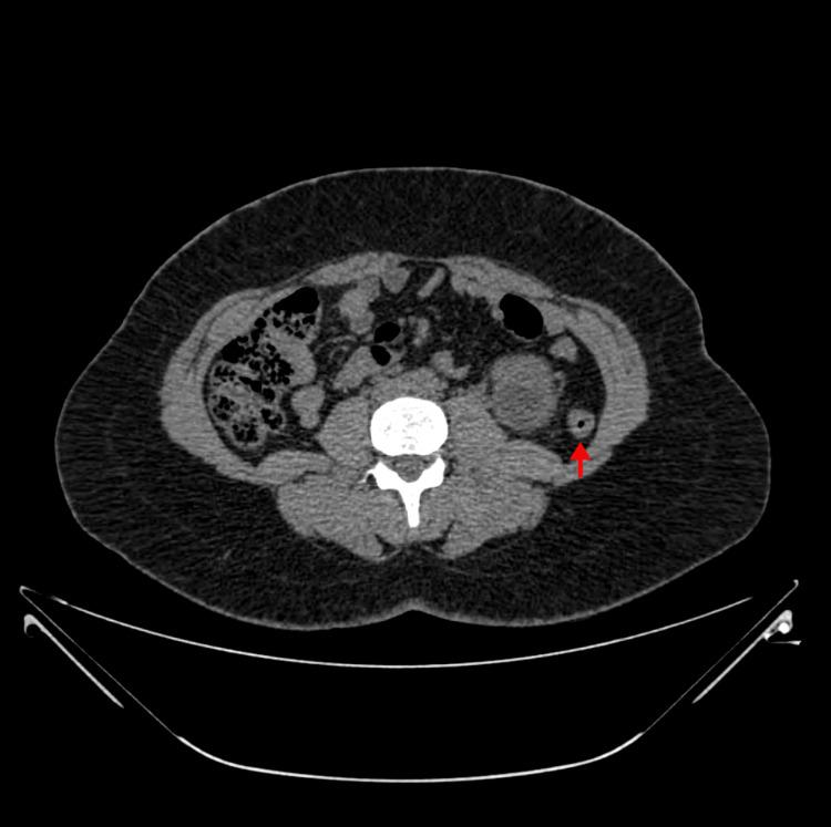 https://cdn.ncbi.nlm.nih.gov/pmc/blobs/4ffe/8297111/703173c2ae4b/cureus-0013-00000015827-i03.jpg