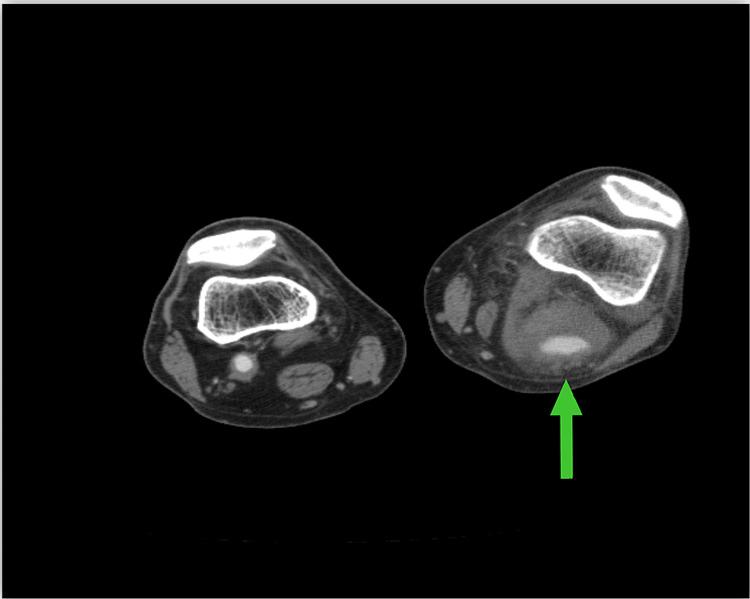 https://cdn.ncbi.nlm.nih.gov/pmc/blobs/4fff/8286778/de62c9b3835f/cureus-0013-00000015746-i01.jpg