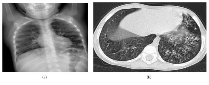 https://cdn.ncbi.nlm.nih.gov/pmc/blobs/5017/5702932/1e79553d9d9b/CRII2017-2846928.002.jpg