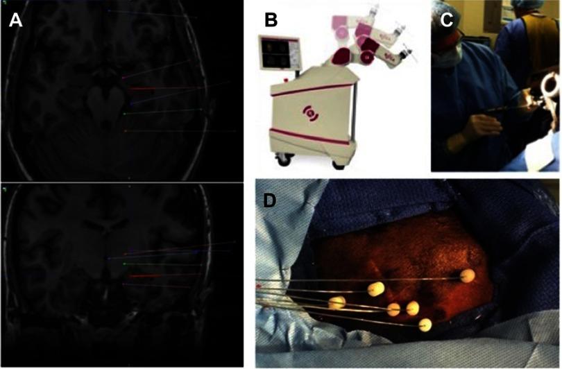 https://cdn.ncbi.nlm.nih.gov/pmc/blobs/5032/6610288/071e177e0634/NDT-15-1701-g0001.jpg