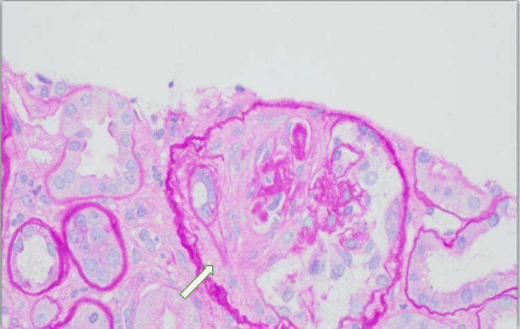 https://cdn.ncbi.nlm.nih.gov/pmc/blobs/5038/12122051/5ae9b87b928e/cureus-0017-00000083202-i04.jpg