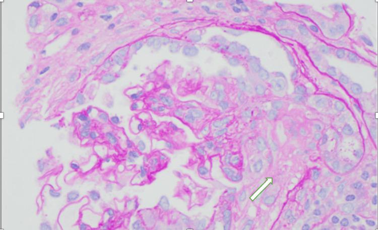 https://cdn.ncbi.nlm.nih.gov/pmc/blobs/5038/12122051/68db8b5c4a32/cureus-0017-00000083202-i03.jpg