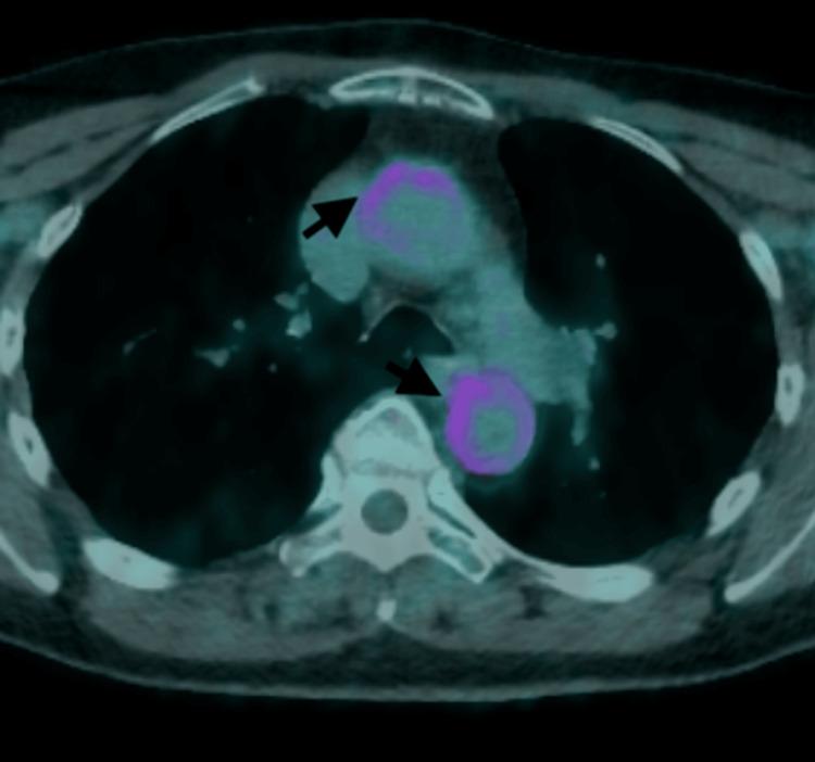 https://cdn.ncbi.nlm.nih.gov/pmc/blobs/5071/11150049/47d89e4b6d96/cureus-0016-00000059686-i04.jpg