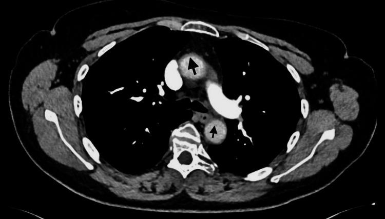 https://cdn.ncbi.nlm.nih.gov/pmc/blobs/5071/11150049/76c11fcfa662/cureus-0016-00000059686-i03.jpg