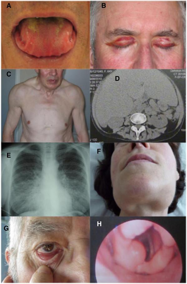 https://cdn.ncbi.nlm.nih.gov/pmc/blobs/509d/3495844/218aa6374177/1750-1172-7-54-1.jpg