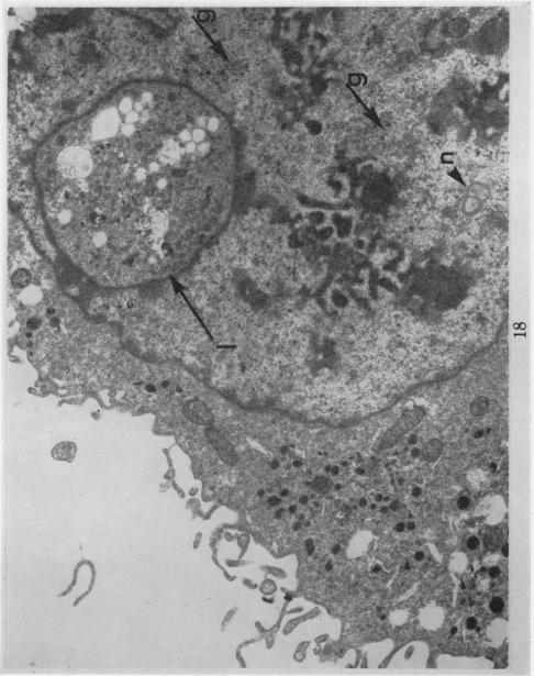 https://cdn.ncbi.nlm.nih.gov/pmc/blobs/50ce/2008861/d1eacfbb3563/brjcancer00361-0212-a.jpg