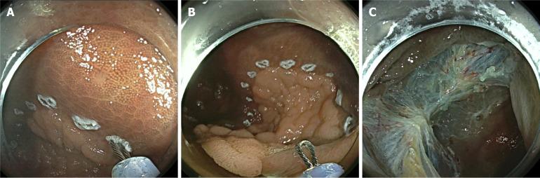 https://cdn.ncbi.nlm.nih.gov/pmc/blobs/50d5/12264792/c5dcffa6b9c9/wjge-17-7-107746-g004.jpg