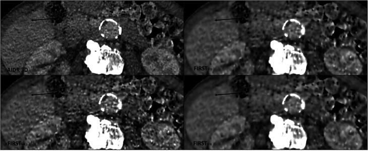 https://cdn.ncbi.nlm.nih.gov/pmc/blobs/5114/9780754/2297f566c60e/10.1177_02841851211070119-fig3.jpg