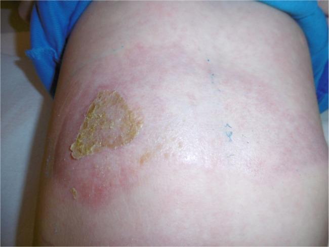 https://cdn.ncbi.nlm.nih.gov/pmc/blobs/513b/6239097/094fcb6b5072/ccid-11-579Fig14.jpg