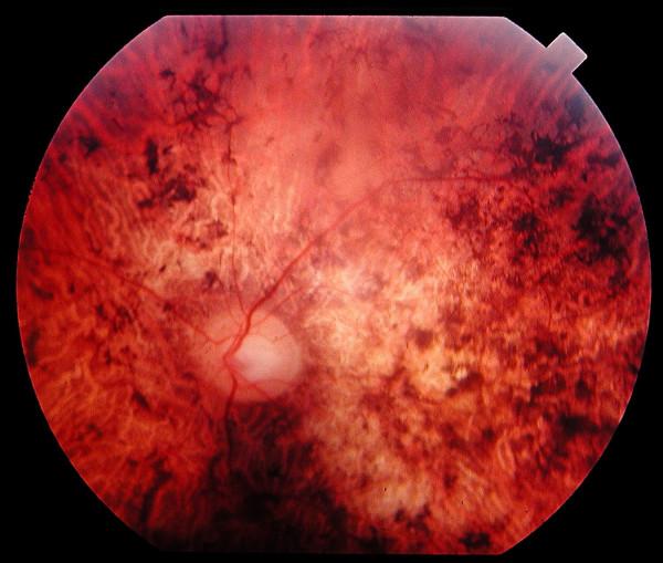 https://cdn.ncbi.nlm.nih.gov/pmc/blobs/5177/1808442/91fa4f008cbf/1750-1172-2-7-1.jpg