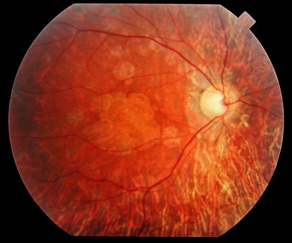 https://cdn.ncbi.nlm.nih.gov/pmc/blobs/5177/1808442/fc64a3c9a531/1750-1172-2-7-3.jpg