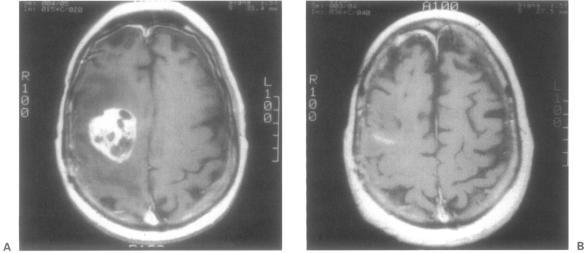 https://cdn.ncbi.nlm.nih.gov/pmc/blobs/518e/1656797/18d0eac845ae/skullbase00006-0033-a.jpg