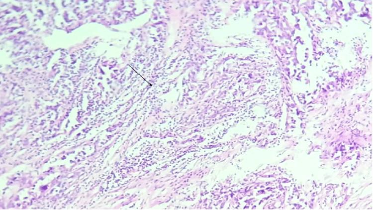 https://cdn.ncbi.nlm.nih.gov/pmc/blobs/51b6/11717322/a2371143a2b3/cureus-0016-00000075479-i03.jpg