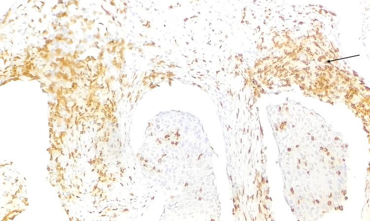https://cdn.ncbi.nlm.nih.gov/pmc/blobs/51b6/11717322/ec12f1c6636d/cureus-0016-00000075479-i04.jpg