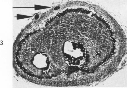 https://cdn.ncbi.nlm.nih.gov/pmc/blobs/5228/1965277/3f9eebf35f27/amjpathol00268-0110-c.jpg