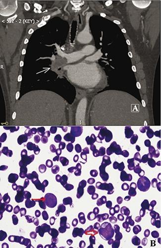 https://cdn.ncbi.nlm.nih.gov/pmc/blobs/5256/4378208/1e29b09826d0/hr-2015-1-5714-g001.jpg