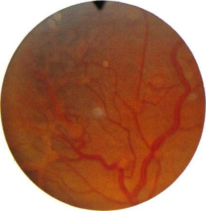 https://cdn.ncbi.nlm.nih.gov/pmc/blobs/527e/1041321/a87a67237db9/brjopthal00621-0036-d.jpg