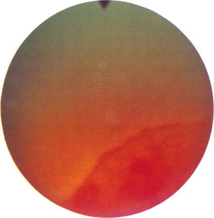https://cdn.ncbi.nlm.nih.gov/pmc/blobs/527e/1041321/bb825400a158/brjopthal00621-0036-b.jpg