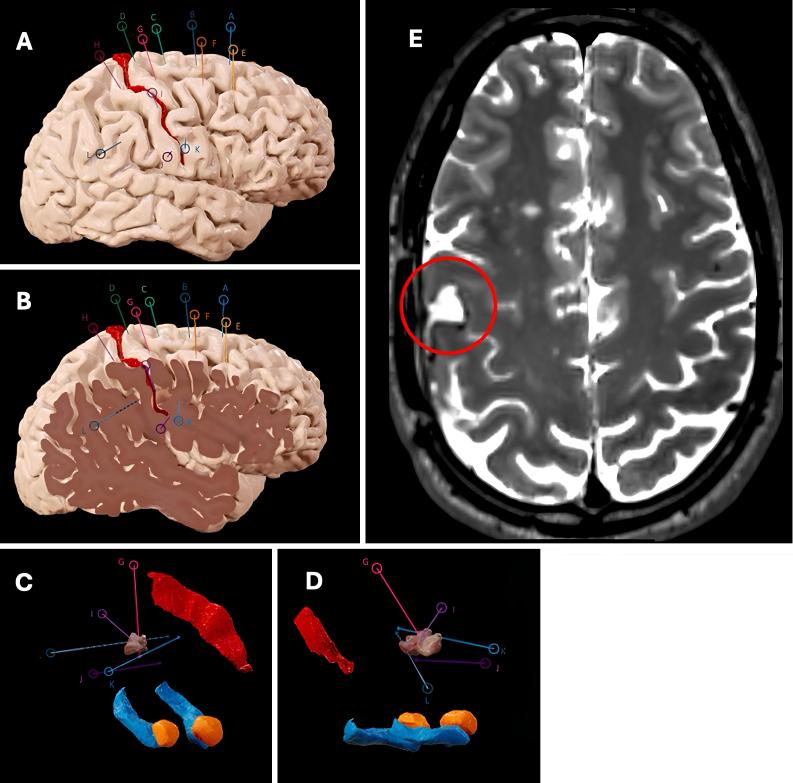 https://cdn.ncbi.nlm.nih.gov/pmc/blobs/52ab/12036357/3413afb7d75a/CASE24667_figure_4.jpg