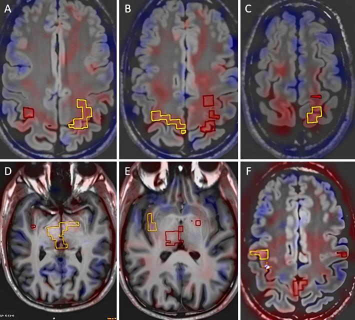 https://cdn.ncbi.nlm.nih.gov/pmc/blobs/52ab/12036357/6527f83e76d0/CASE24667_figure_3.jpg