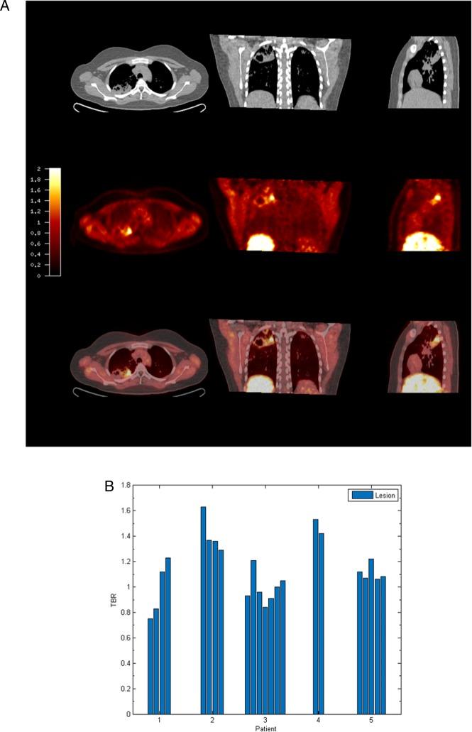 https://cdn.ncbi.nlm.nih.gov/pmc/blobs/52b2/5136721/2893bf591169/thoraxjnl-2015-207402f01.jpg