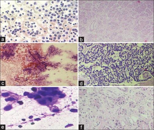 https://cdn.ncbi.nlm.nih.gov/pmc/blobs/52b3/11108040/cf7dddcaf483/JCytol-41-123-g001.jpg