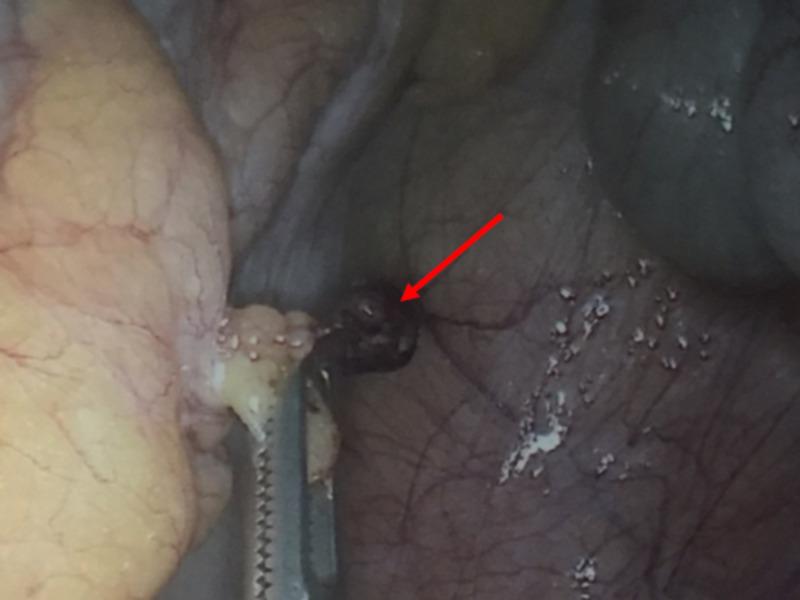 https://cdn.ncbi.nlm.nih.gov/pmc/blobs/52b7/7593212/5cf36cd1c151/cureus-0012-00000010689-i04.jpg