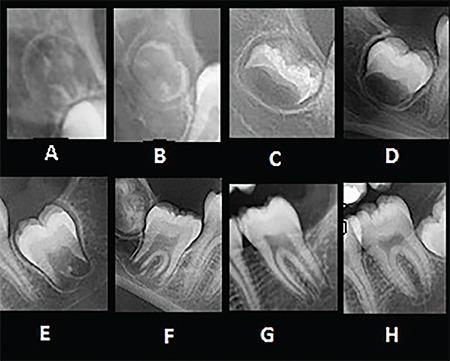 https://cdn.ncbi.nlm.nih.gov/pmc/blobs/52c2/10986459/bc8e3d5bb8bf/tjo-37-56-g1.jpg