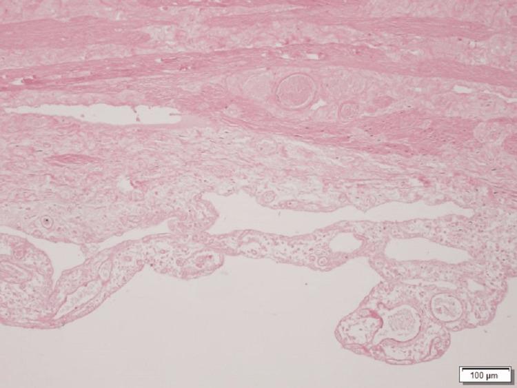 https://cdn.ncbi.nlm.nih.gov/pmc/blobs/52fb/10575247/45359853db18/cureus-0015-00000045167-i05.jpg