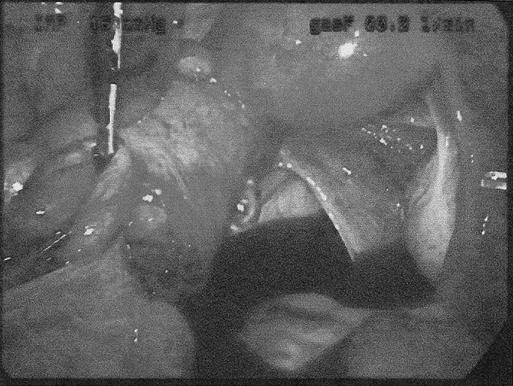 https://cdn.ncbi.nlm.nih.gov/pmc/blobs/5337/3030804/eb8c4e717e25/jsls-13-4-620-g04.jpg