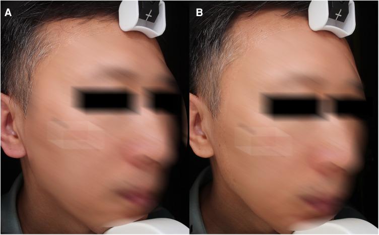 https://cdn.ncbi.nlm.nih.gov/pmc/blobs/5367/10025463/05dd3b3f6774/fsurg-10-1076848-g005.jpg
