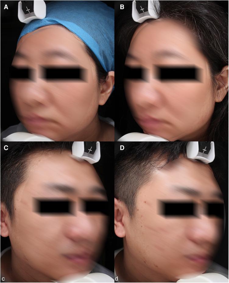 https://cdn.ncbi.nlm.nih.gov/pmc/blobs/5367/10025463/cb2b2d18ad83/fsurg-10-1076848-g004.jpg