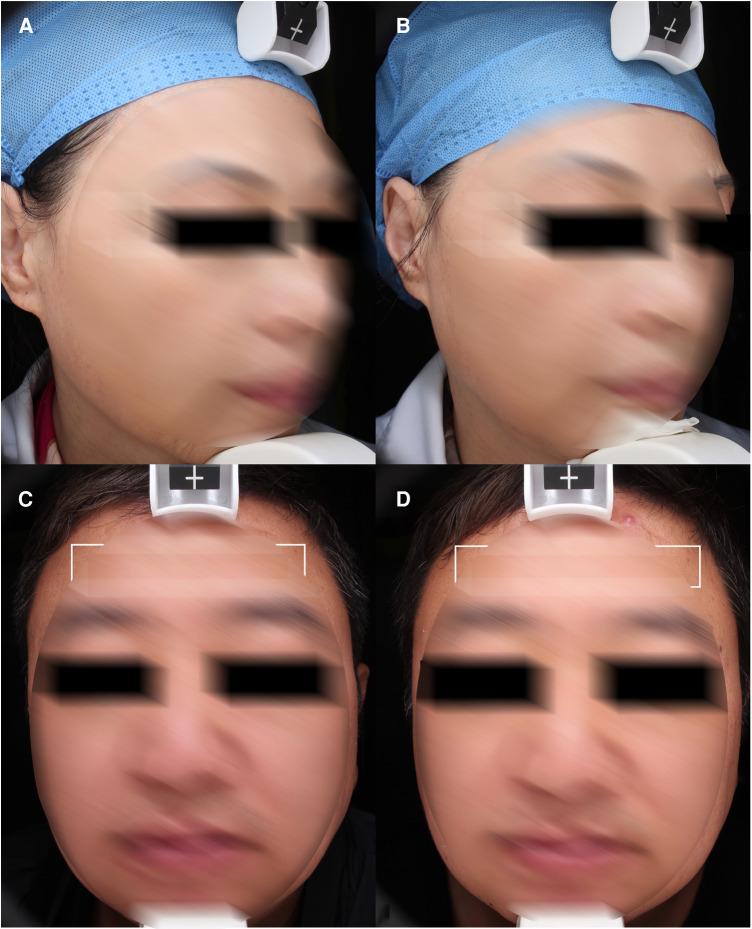 https://cdn.ncbi.nlm.nih.gov/pmc/blobs/5367/10025463/ccad34a4a640/fsurg-10-1076848-g003.jpg