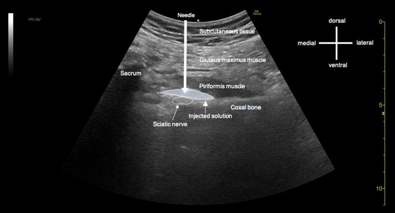 https://cdn.ncbi.nlm.nih.gov/pmc/blobs/540a/9703950/b95d89a27162/amjcaserep-23-e938966-g002B.jpg