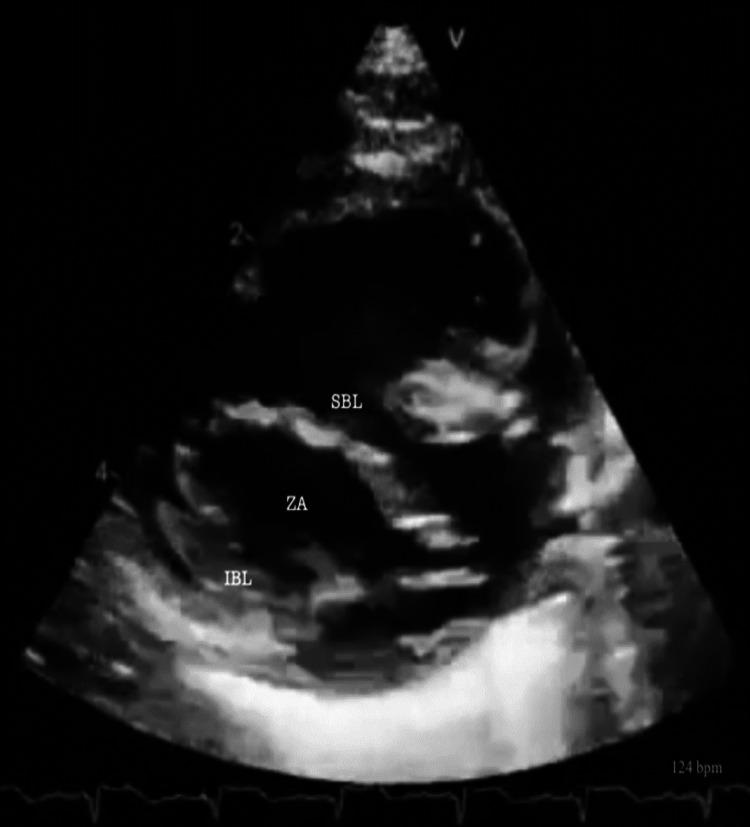 https://cdn.ncbi.nlm.nih.gov/pmc/blobs/5413/11709140/382baf798f36/cureus-0016-00000075388-i04.jpg