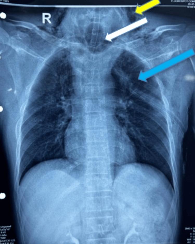 https://cdn.ncbi.nlm.nih.gov/pmc/blobs/54d8/12007486/0cb2d6e7eafb/cureus-0017-00000080826-i01.jpg