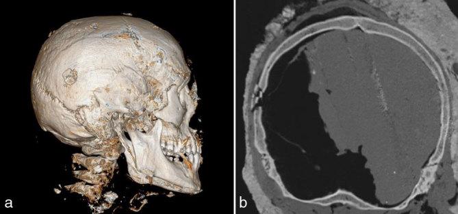https://cdn.ncbi.nlm.nih.gov/pmc/blobs/5504/6243300/8d520a4ef7b1/bjrcr.20150304.g003.jpg