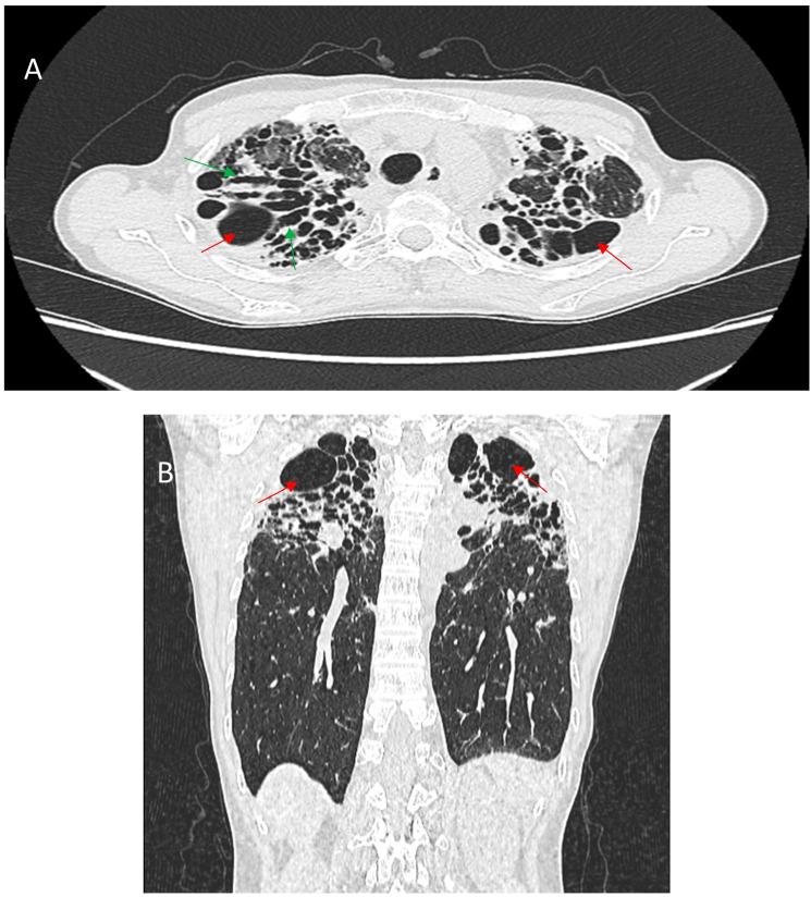 https://cdn.ncbi.nlm.nih.gov/pmc/blobs/5505/11989801/b07dd8635c0b/jcm-14-02381-g006.jpg