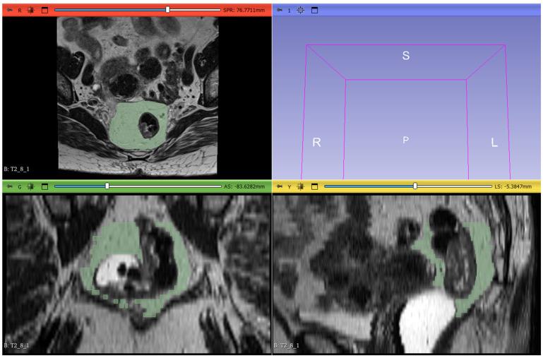 https://cdn.ncbi.nlm.nih.gov/pmc/blobs/5536/12031397/da91fbd67e82/tomography-11-00044-g002.jpg