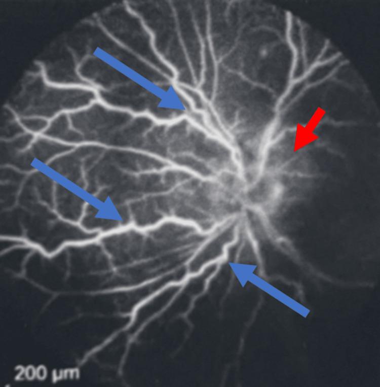 https://cdn.ncbi.nlm.nih.gov/pmc/blobs/5566/12028062/1a81e8d652cc/cureus-0017-00000081240-i01.jpg