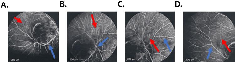 https://cdn.ncbi.nlm.nih.gov/pmc/blobs/5566/12028062/853261774316/cureus-0017-00000081240-i02.jpg