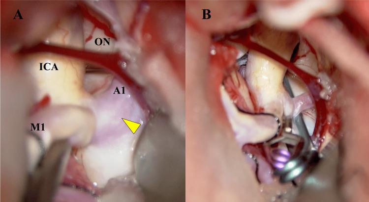 https://cdn.ncbi.nlm.nih.gov/pmc/blobs/55a3/11502117/840a9bbb3332/cureus-0016-00000070122-i03.jpg