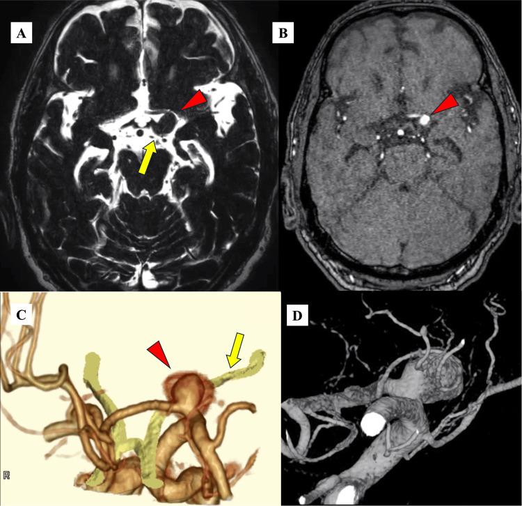 https://cdn.ncbi.nlm.nih.gov/pmc/blobs/55a3/11502117/857820edbb03/cureus-0016-00000070122-i02.jpg