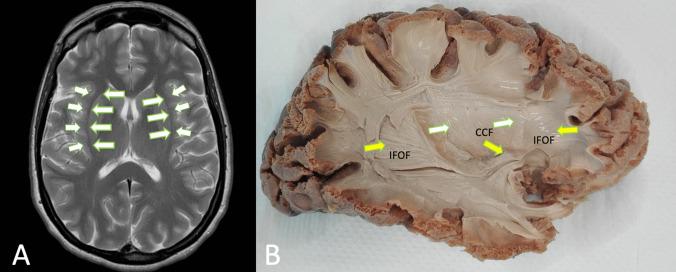 https://cdn.ncbi.nlm.nih.gov/pmc/blobs/55a7/11903521/a1c0c7def9da/701_2025_6488_Fig1_HTML.jpg